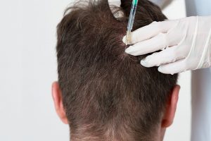 PRP bei Haarausfall und Haartransplantationen